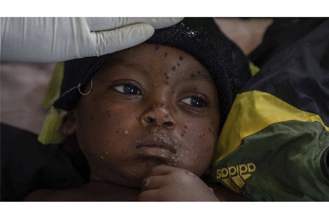 Ein an Mpox erkranktes Kind liegt in einem Krankenhaus der ostkongolesischen Provinz Süd-Kivu.