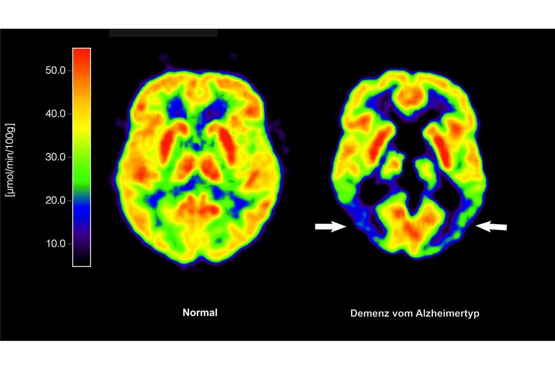 Entscheidung über die Zulassung für Medikament zur Behandlung von Alzheimer-Patienten verzögert sich. (Archivbild)