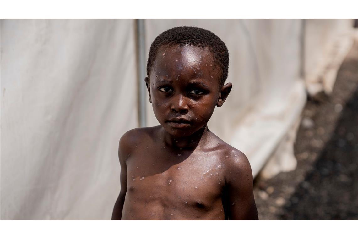 Für Kinder kann Mpox besonders gefährlich sein (Archivbild)