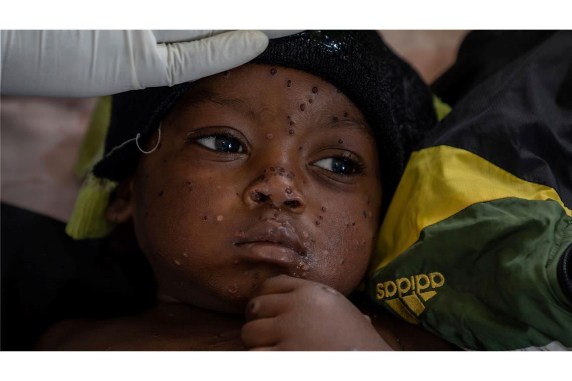 Neue Tests sollen die Ausbreitung von Mpox eindämmen helfen. (Archivbild)